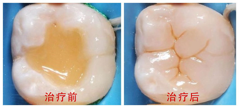 补牙价格是多少