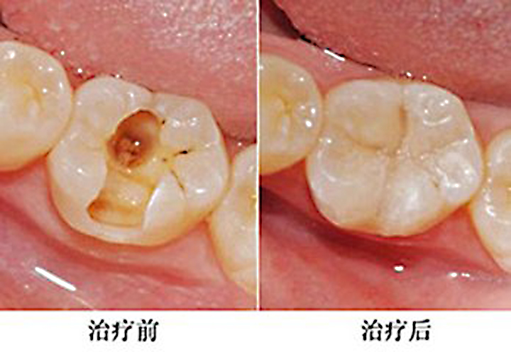 因拔牙针断口腔数天后才取出