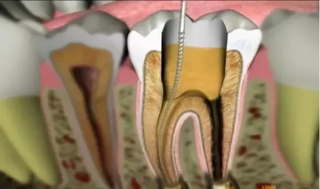 牙龈炎的形成原因有哪些