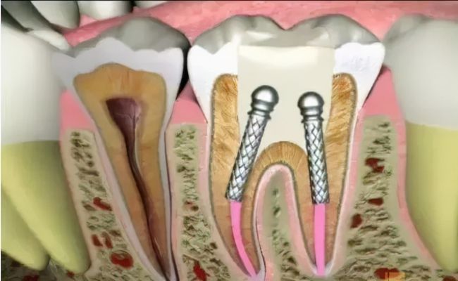 根管治疗有哪些操作步骤?