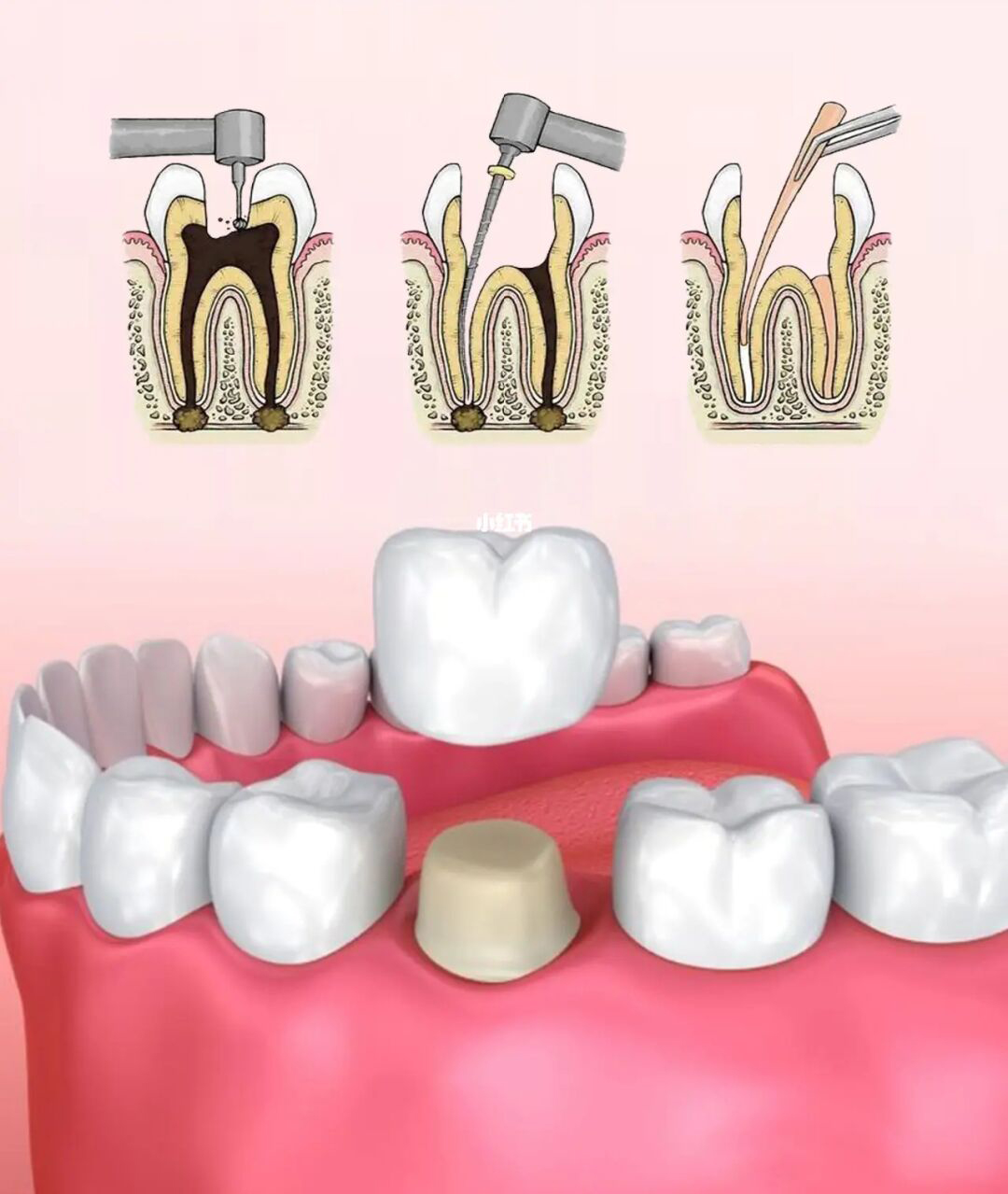 牙龈出血的六大原因分析是什么