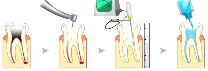 简述根管治疗术