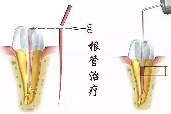 蛀牙会引起牙龈炎吗？