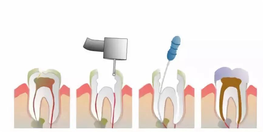 牙科医生的根管治疗有哪些操作步骤?