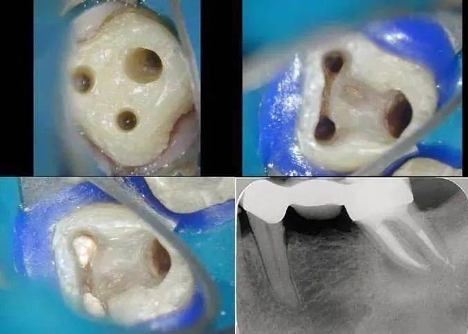 牙周炎的症状及治疗方法