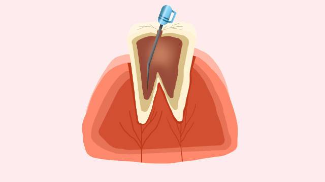 预防牙龈炎发生的方法
