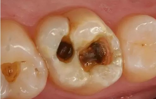 牙周袋溢脓怎么治疗？