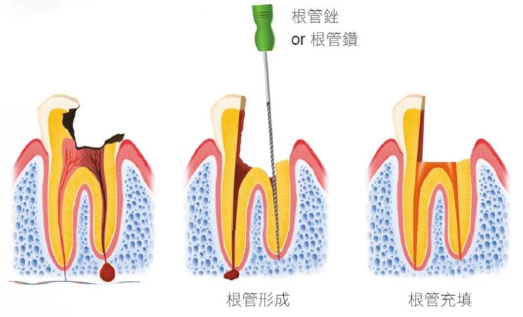 为什么有人做了根管治疗还会牙疼