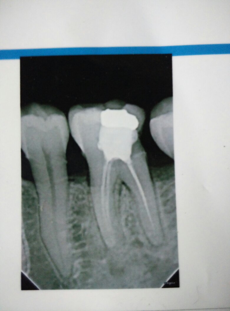 根管治疗后牙痛？