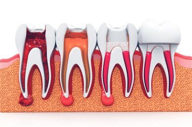 带环在隐裂牙根管治疗中的临床应用