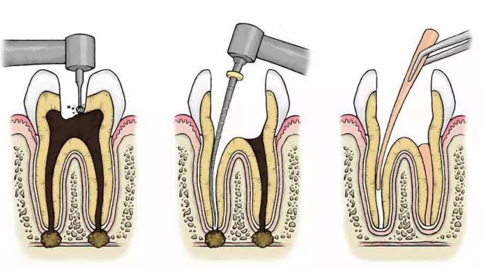 口腔牙髓钙化形式