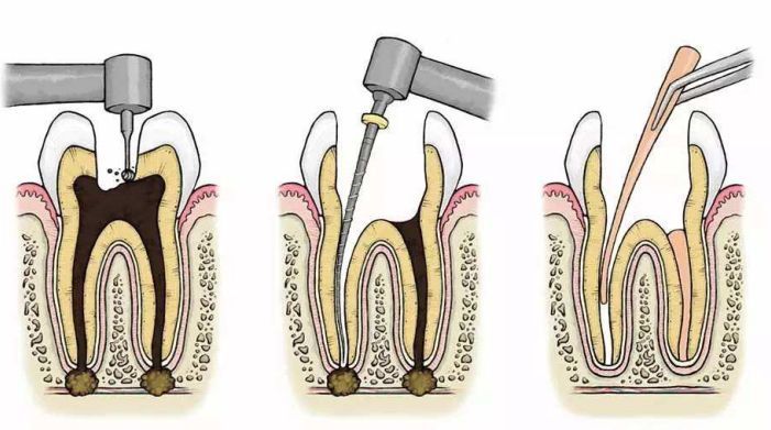 根管治疗的全过程