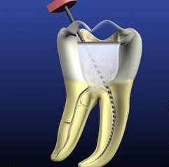牙痛的治疗方法