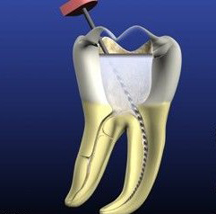 根管治疗为什么有的要几次，有的一次就可以完成？
