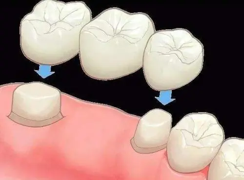 全瓷牙的粘固方法及粘固剂