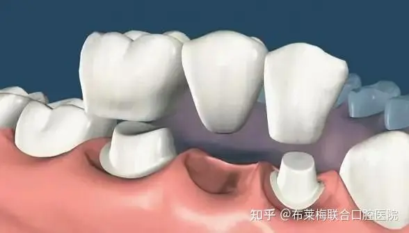 后牙烤瓷牙套用什么材料的好呢