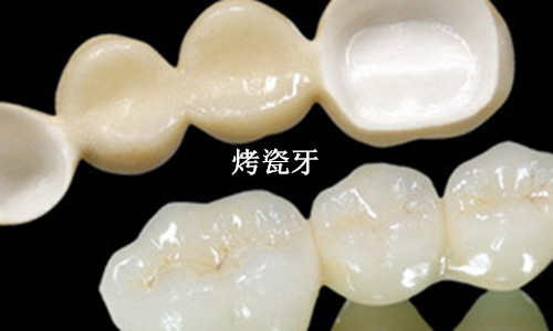 烤瓷牙前应注意哪些事情？