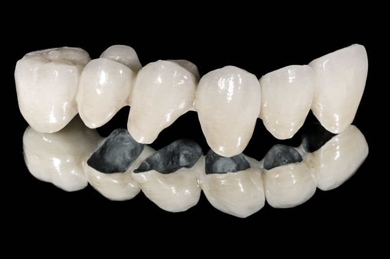 瓷贴面美白牙齿有哪些优势