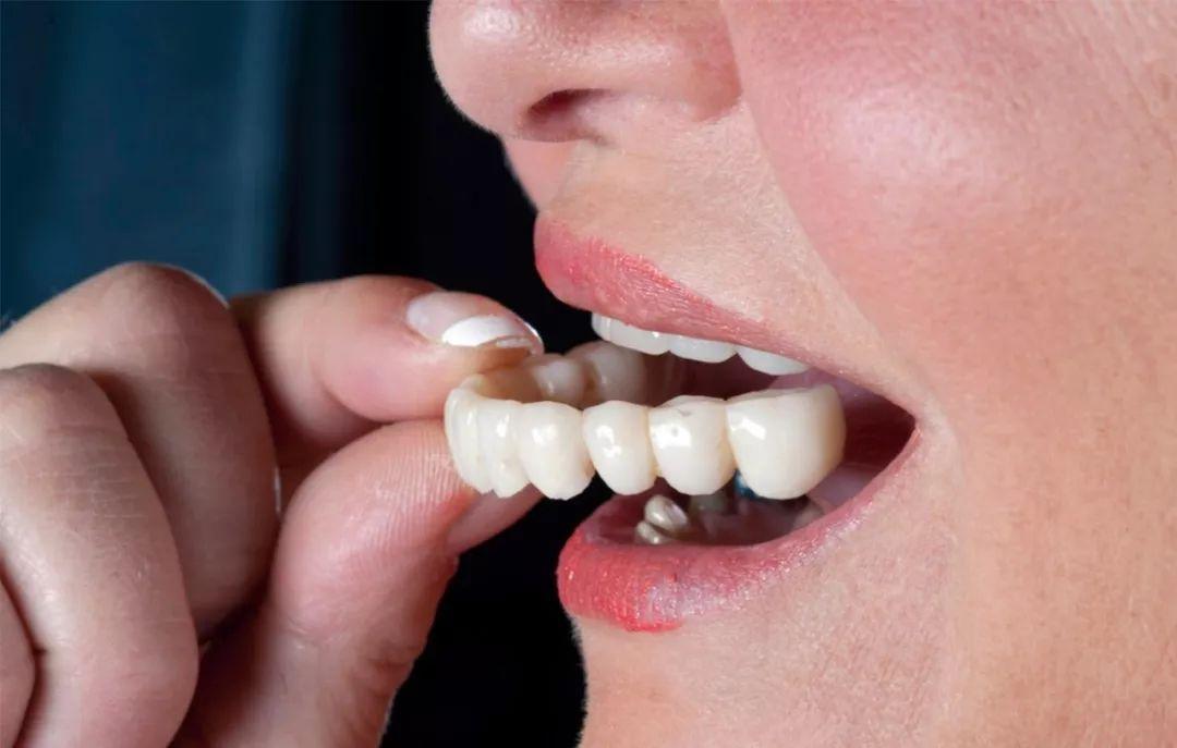 牙齿缺损——成人的老鼠牙需要修复吗