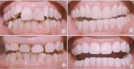 美容冠3D雕齿的技术能否矫正畸形牙