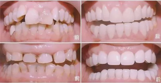 使用烤瓷牙的四个优点