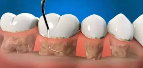 关于洗牙的常见问题解答