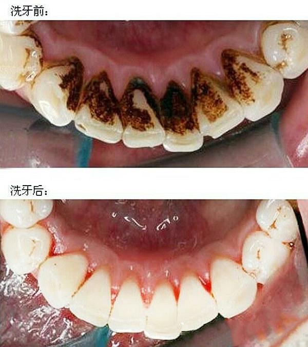 关于洗牙的相关问答