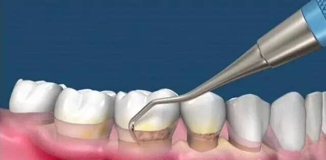 洗牙的周期是多长一次？