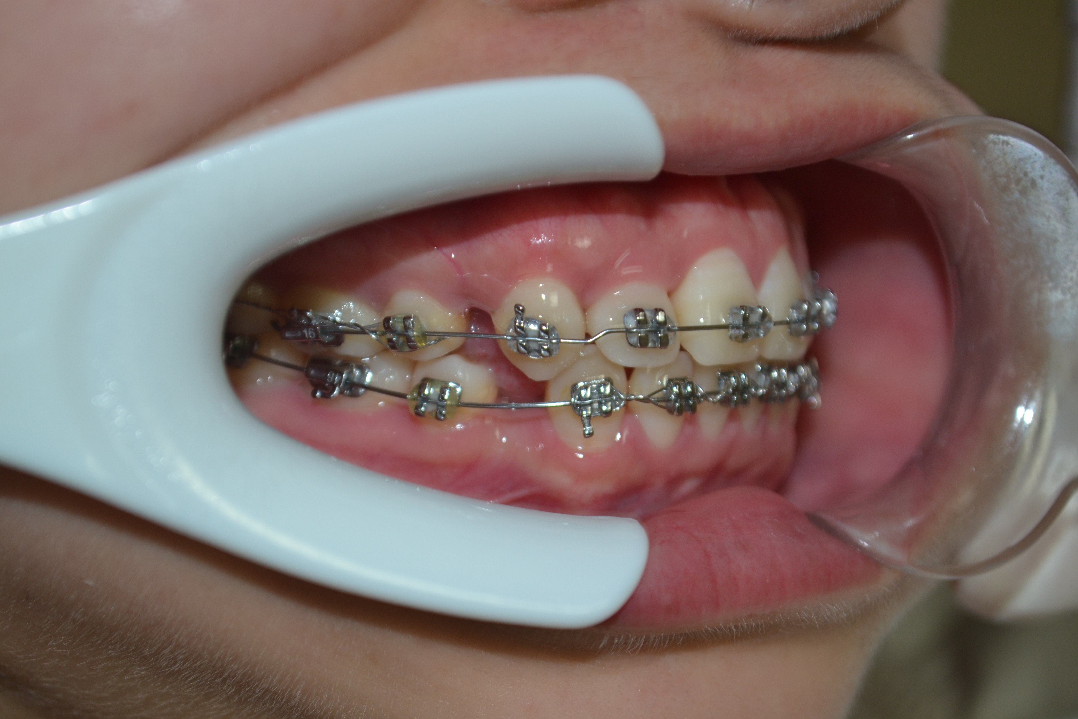 你了解牙齿矫正治疗吗?