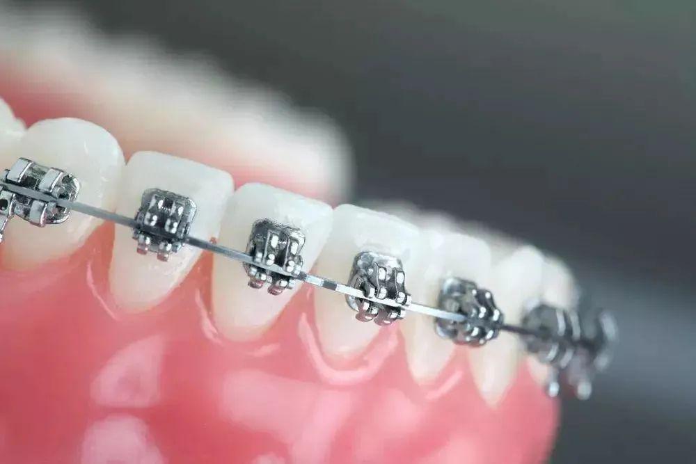 牙齿矫正要如何护理呢