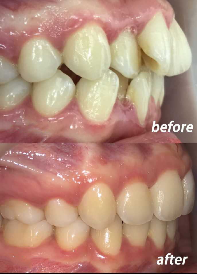 做牙齿矫正会导致牙龈萎缩吗？