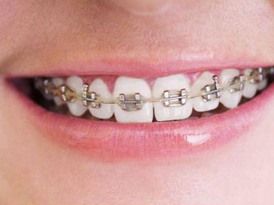 即刻固定义齿修复前牙的美学价值
