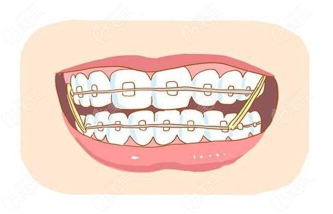 活动修复与固定义齿修复的区别