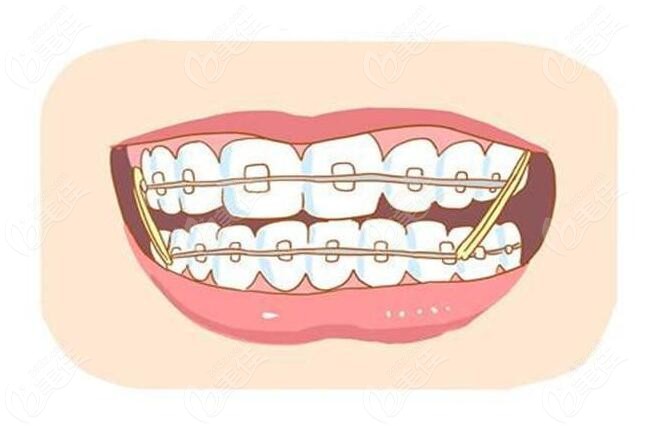 牙齿地包天牙齿矫正方法