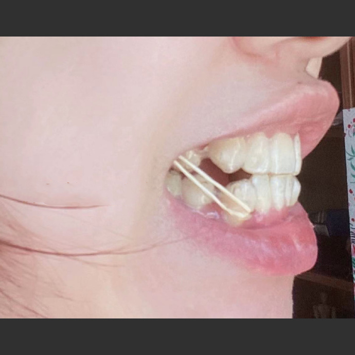 成人是否可以做牙齿矫正