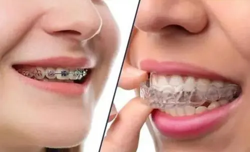 前牙缺失怎么修复