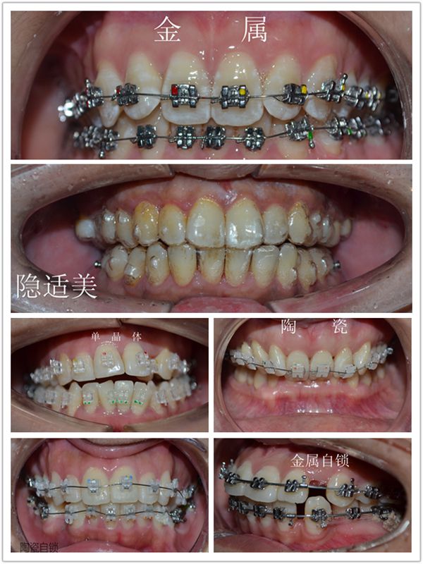 无托槽隐形矫治牙齿矫正技术（invisalign）