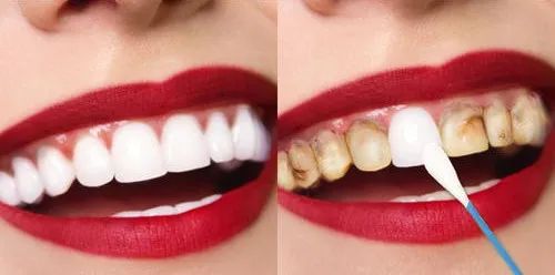 乳牙龋病能否预防