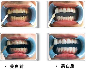 如何缓解洁牙酸痛