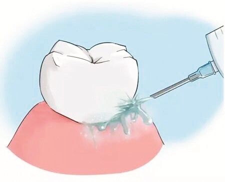 怎样选择牙齿美白方法