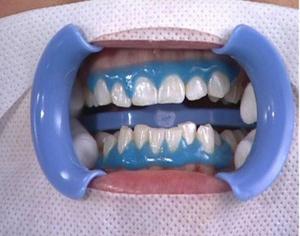 牙齿变色原因不同 美白不能一厢情愿