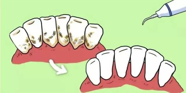 洗牙到底是护牙还是在伤牙？看看你就知道