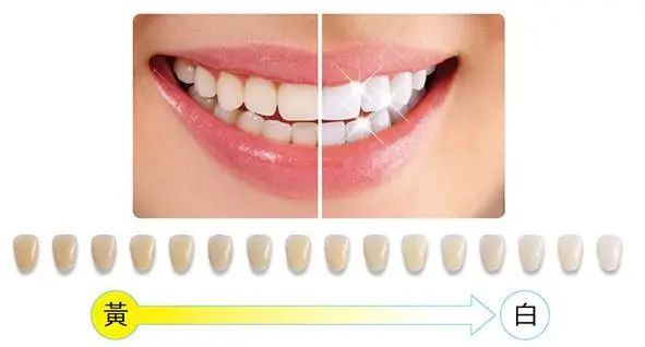 冷光美牙：45分钟告别色素牙