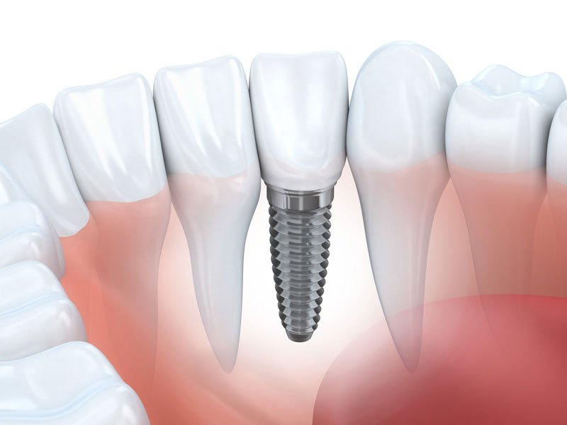 种植牙维护方法有哪些 定期复诊维护较关键