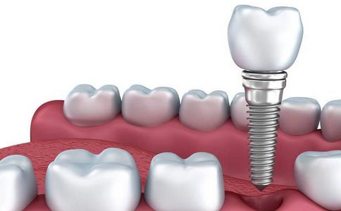 种植牙的材料应该如何挑选