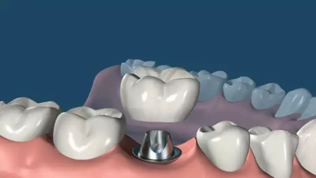 牙齿种植护理的步骤