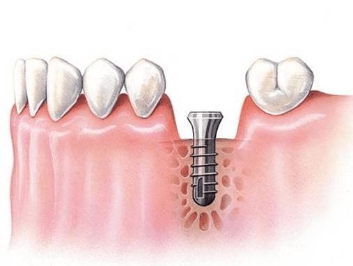 种植牙的周期