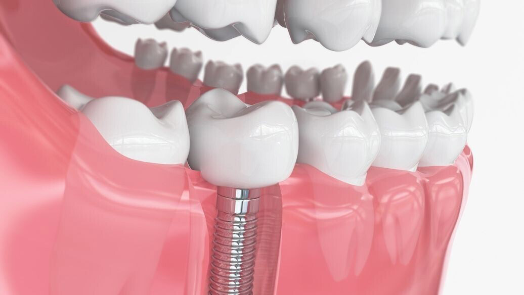 怎么治疗种植牙术后疼痛呢