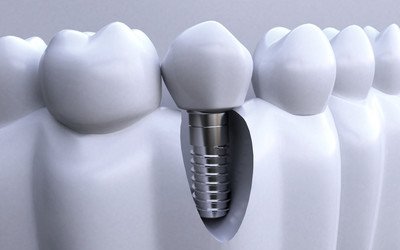 种植牙修复的基本过程