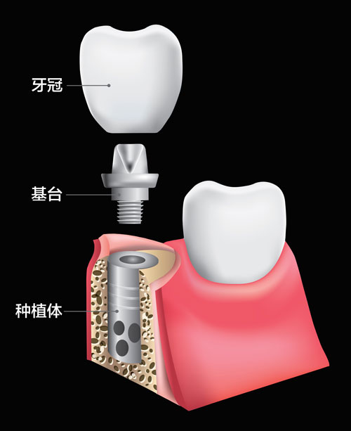 计算机速导口腔种植，让缺牙快速“归位